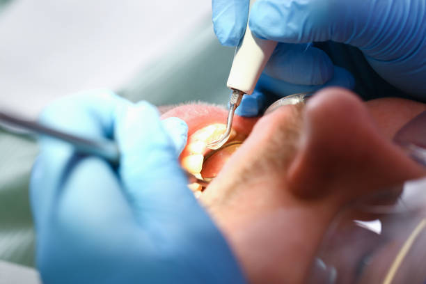 Best Emergency Dentist for Knocked-Out Tooth in Caon City, CO